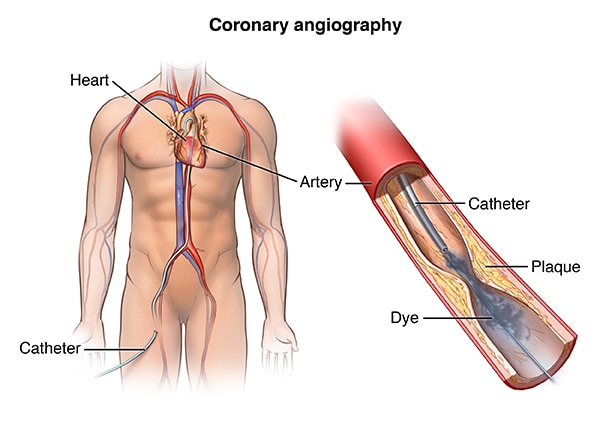 angiography treatment in Parel mumbai
                                            