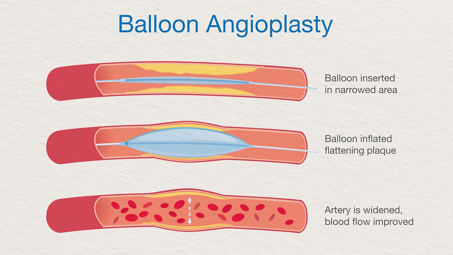 angioplasty service in mumbai
                                            