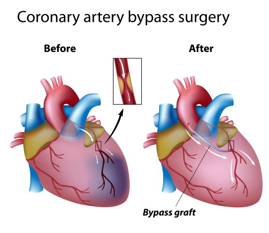 coronary angiogram care centre in Parel 
                                            